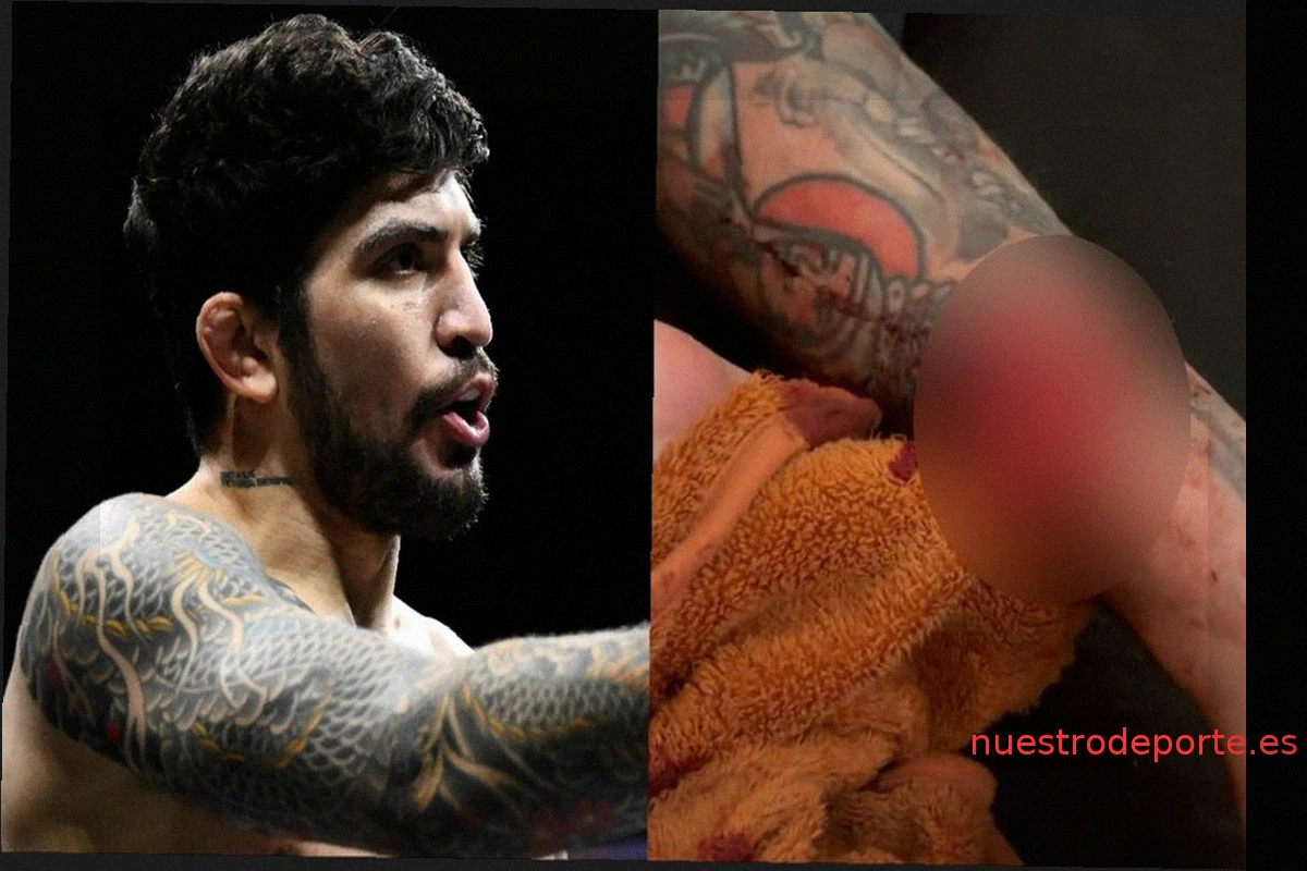 Dillon Danis comparte imágenes impactantes de la lesión que forzó su retirada del combate contra Mike Perry